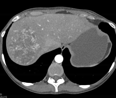 Cirrhosis With Portal Hypertension And Recanalization Of The Umbilical