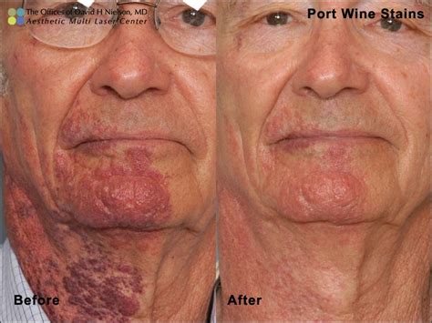 Port Wine Stain Before And After