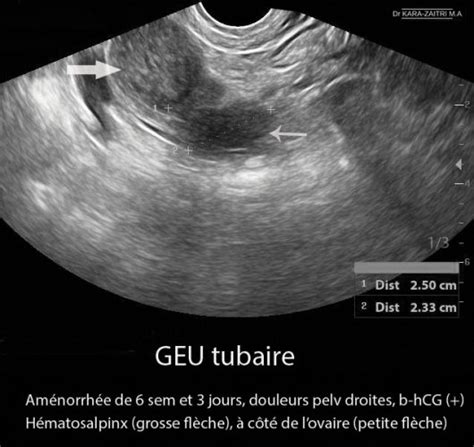 Grossesse Extra Ut Rine Geu Chographie Dr Kara Zaitri M A