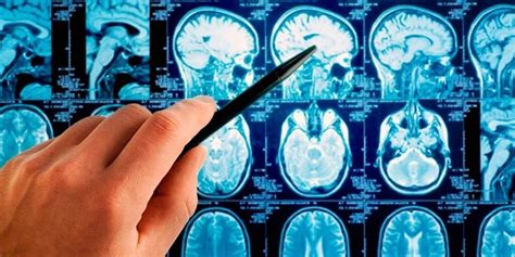 Астроцитома головного мозга - симптомы, диагностика и лечение в лучших ...