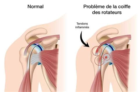 R Paration De La Coiffe Des Rotateurs Sous Arthroscopie Dr Waitzenegger