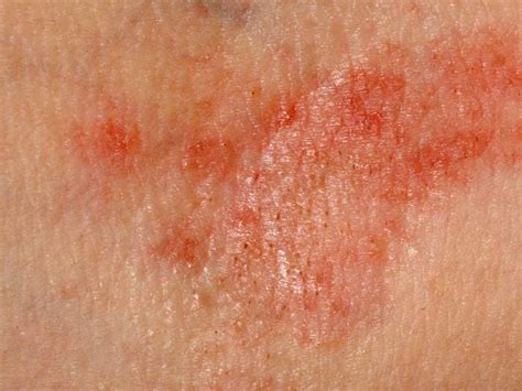 Dermatitis Pictures And Symptoms