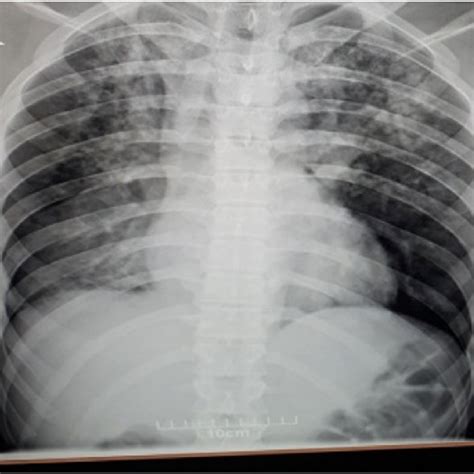 Chest X Ray Of The Patient Showed Ground Glass Opacities Download Scientific Diagram