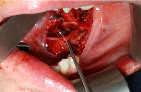 Figure 5 From Sublingual Gland Excision A Dissection Carried Out