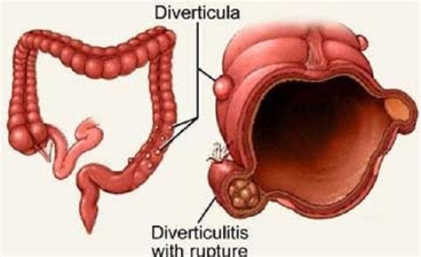 Intestino Diverticulosis Diverticulitis Aguda Diverticulitis Del Colon