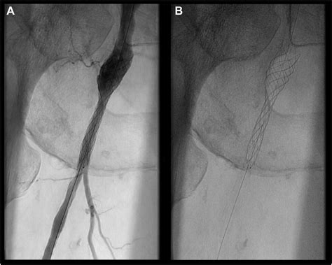 Off Label Use Of Interwoven Carotid Stent In Common Femoral Artery