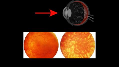 Birdshot Chorioretinopathy Symptoms And Causes Diagnosis Treatment