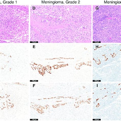 Prostate Specific Membrane Antigen Psma And Cd31 Colocalization