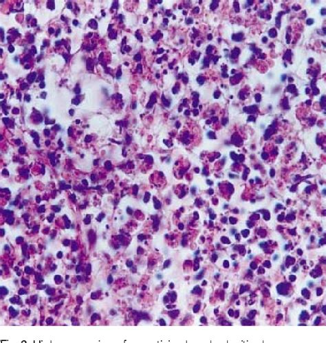 Figure 3 From Hemophagocytic Syndrome Associated With Kikuchi S Disease