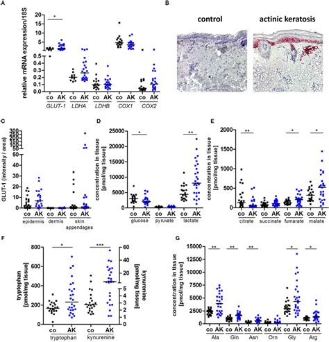 Increased Lactate And Amino Acid Levels In Actinic Keratosis Lesions