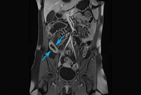 MRI for Crohn’s Disease & Small Bowel in Melbourne