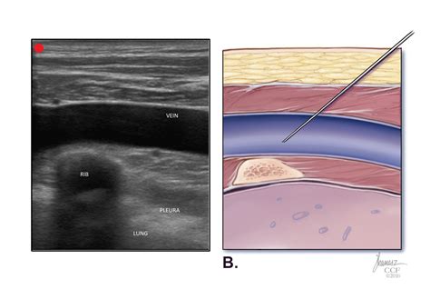 The Subclavian Line The Line Of Champions Emergency Medicine Training