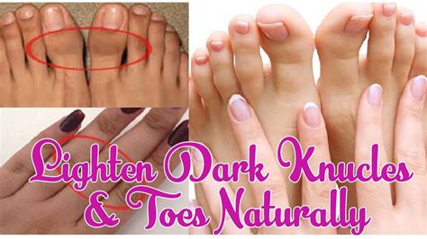 How To Lighten Dark Knuckles And Toes Naturally Beauty Tips YouTube