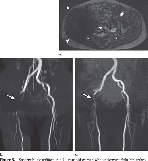 Fetal Scalp Electrode Semantic Scholar