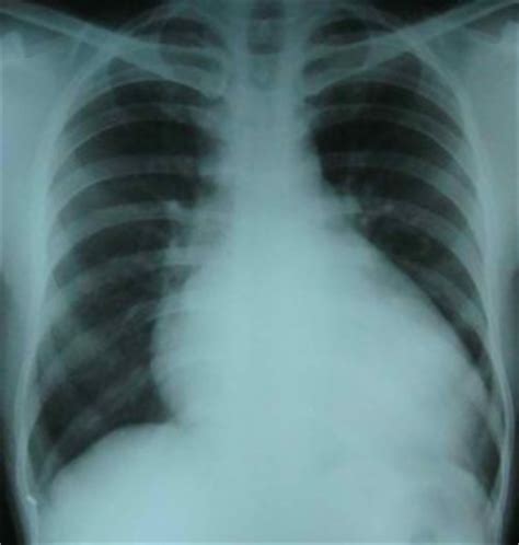 » Cardiomegaly – Causes, Treatment, Symptoms, Pictures, Types