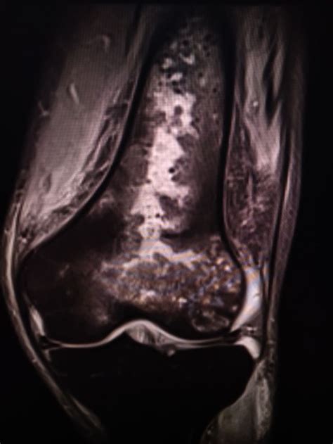 Osteomyelitis With Intraosseous Abscess Radiology