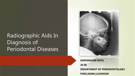 Radiographic Aids In The Diagnosis Of Periodontal Diseases Ppt