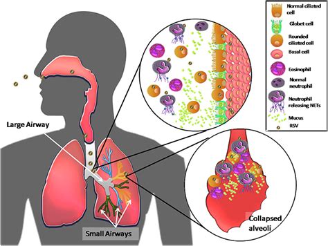 Frontiers Host Components Contributing To Respiratory Syncytial Virus Pathogenesis