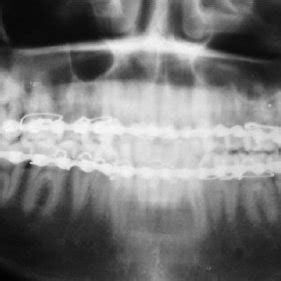 Orthopantomograph Showing Internal Fixation Of Right Parasymphysis And