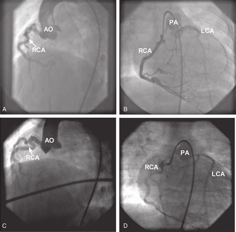 Cardiac Catheterization Pictures