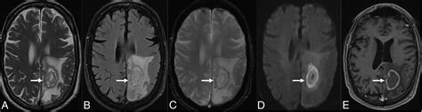 Unpacking The Cns Manifestations Of Epstein Barr Virus An Imaging Perspective American