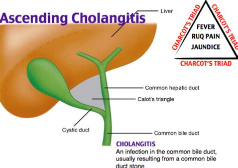 La triade di Charcot – Test Ammissione