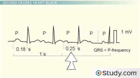 Heart Block: Different Types and Treatment - Lesson | Study.com