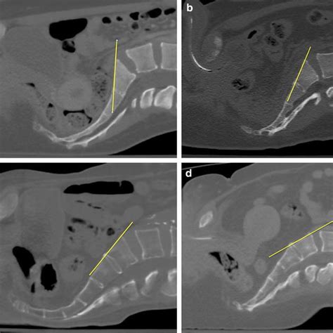 Preoperative Ct Scan With Sagittal Reconstruction At The Midline Download Scientific Diagram