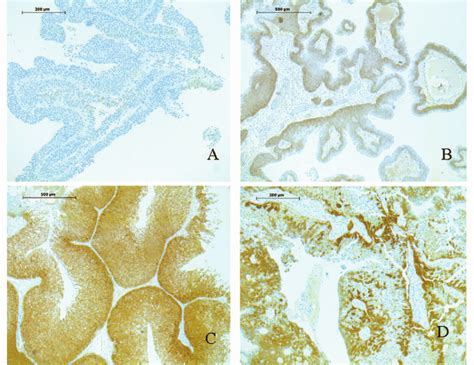 Maspin Immunoreaction In Papillary Urothelial Neoplasms Showing Four