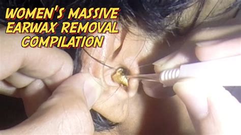 Women S Massive Earwax Removal Compilation Christmas Edition YouTube