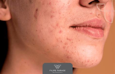 Acne Dicas Para Uma Pele Saud Vel Dr Filipe Farage