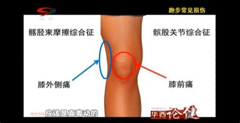 觀觀養生｜跑步常見損傷 每日頭條