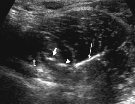 Iliopsoas Bursitis Ultrasound