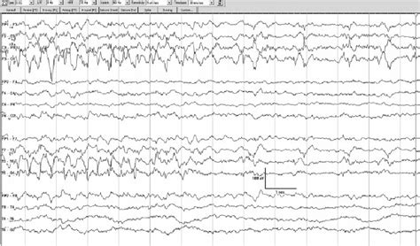 Case 1 Continued End Of Seizure 1 Minute After Eeg In Fig 3 After