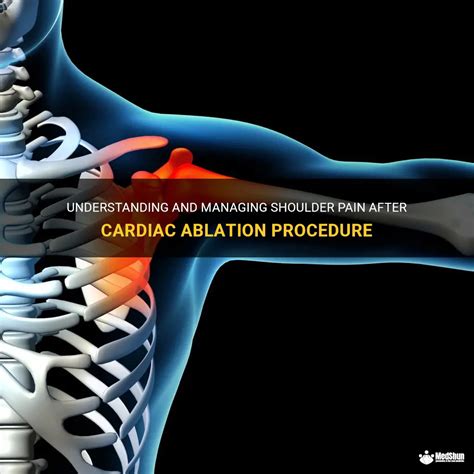 Understanding And Managing Shoulder Pain After Cardiac Ablation Procedure Medshun