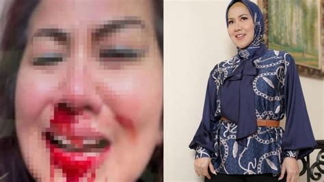 Foto Wajah Venna Melinda Berlumuran Darah Beredar Di Media Sosial