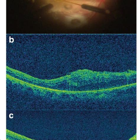 Multimodal Imaging Of The Affected Eye A Intraopeative Fundus