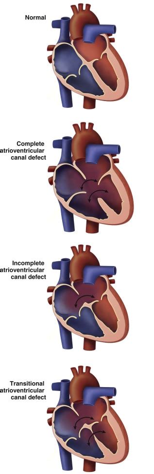 Atrioventricular Canal Defect