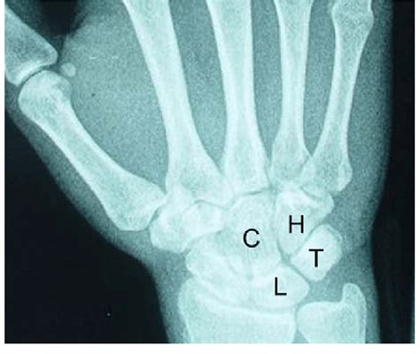 Plain Postero Anterior Radiograph Of The Wrist Showing A Type I