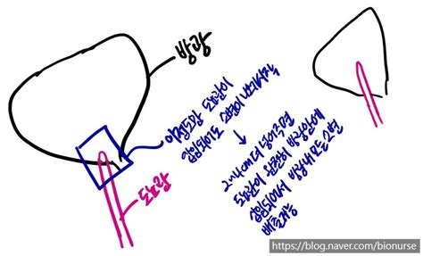 핵심 술기 유치도뇨 술기대사 네이버 블로그