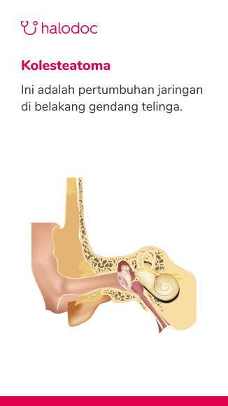 Cara Nak Menghilangkan Sakit Telinga Bagian Dalam