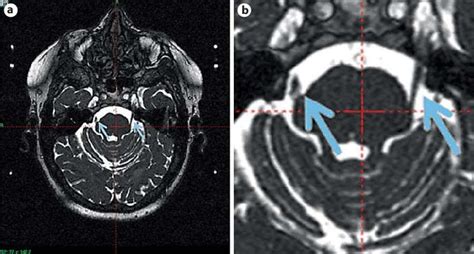 Trigeminal Nerve Mri Brain