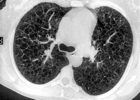 Lymphangioleiomyomatosis Radiologic Pathologic Correlation Radiographics