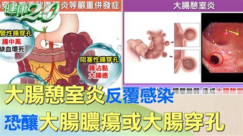 大腸憩室炎反覆感染 恐釀大腸膿瘍或大腸穿孔 健康20 Youtube