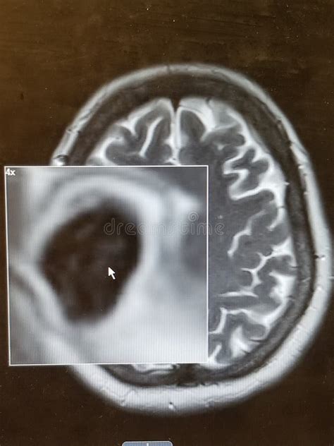 TC Cerebral Con Larva De Cisticercosis De Tenia De Cerdo Imagen De