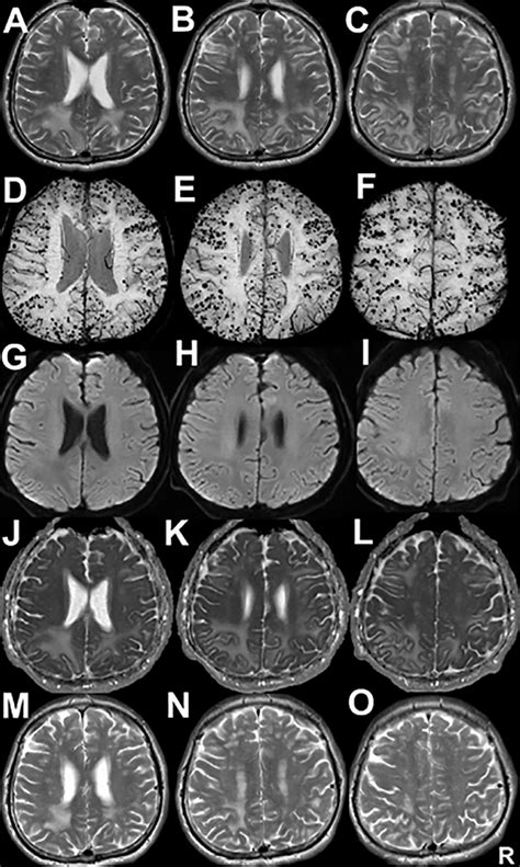 A C Axial T Weighted Spin Echo Sequences Of The Brain On Admission