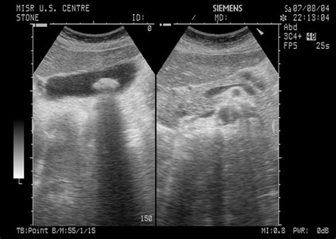 Mbbs Medicine Humanity First Ultrasound Of Gallbladder