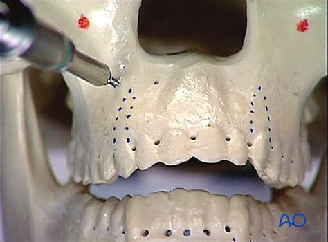 Mandibulomaxillary Fixation Mmf Bone Supported Devices