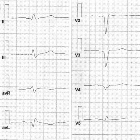 The Patients P A Chest X Ray Showing Isolated Dextrocardia Cardiac