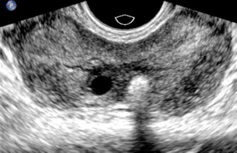 Multiparametric Ultrasound Finds Causes For Male Infertility • Healthcare In